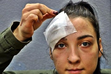 Bakanlık Alnında İğne Unutulan Genç Kız İçin Devreye Girdi