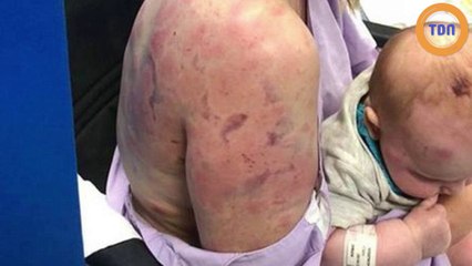 Cette mère a utilisé son corps pour protéger son bébé pendant une très violente tempête de grêle !