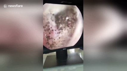 Man has hundreds of ‘mushrooms’ growing inside his ear