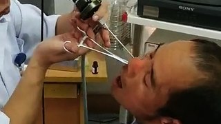 Doctor pulls leech from man’s nose