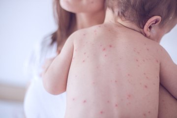 Les remèdes naturels contre la varicelle