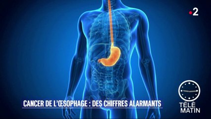 Santé – Cancers de l’œsophage : multipliés par sept en 20 ans !
