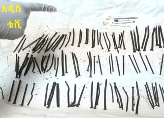 Etiyopyalı Hastanın Midesinden 120 Adet Çivi Çıktı