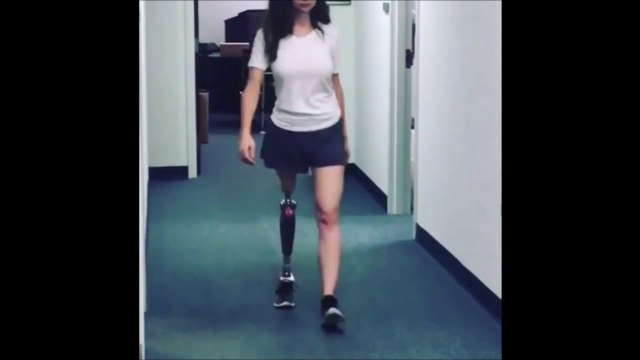 Elle se fait amputer la jambe à 11 ans après un cancer mais continu à vivre ses rêves