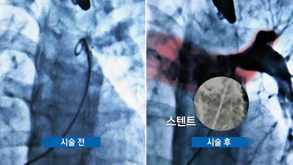 정맥에 스텐트관 넣어 폐동맥 인공판막 시술...세계화 첫발 / YTN