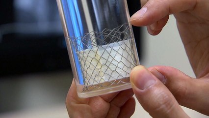 정맥에 스텐트관 넣어 폐동맥 인공판막 시술 / YTN