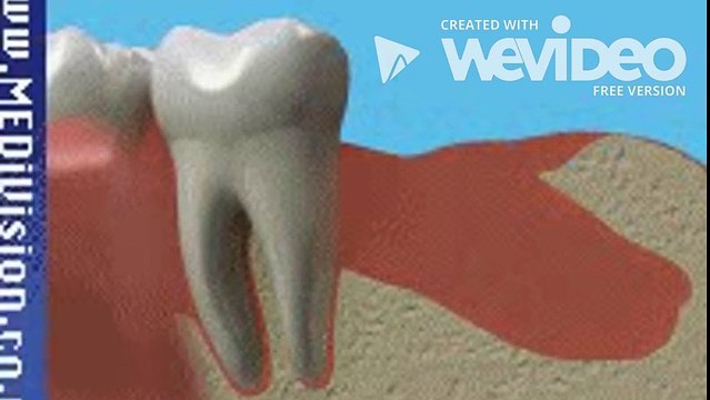 Dental Implants Penrith | Complete Dental Implants Processor