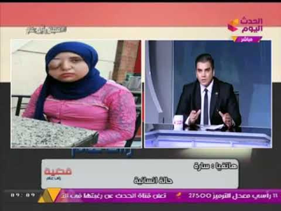 بالفيديو أغرب حالة تشوه خلقي :فتاه تحكي مأساة محاولتها للعلاج من ابشع حالة تشوه خلقي