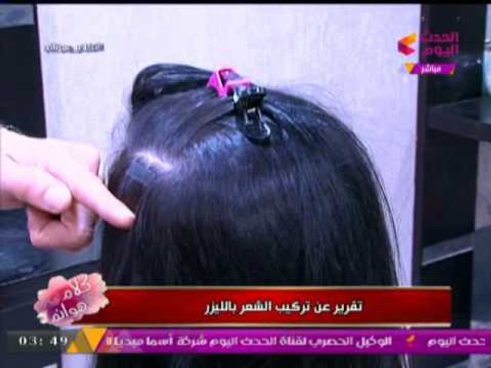 كلام هوانم مع عبير الشيخ |  خبير التجميل يكشف  اسرار "تركيب الشعر بالليزر " ومميزاته