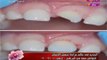 برنامج كلام هوانم |  اخصائي تجميل الاسنان يكشف احدث الطرق في عالم تجميل الاسنان 21-8-2017