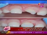 برنامج كلام هوانم |  اخصائي تجميل الاسنان يكشف احدث الطرق في عالم تجميل الاسنان 21-8-2017
