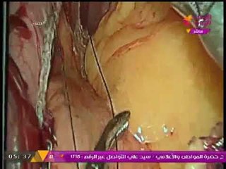 خاص| كاميرا #الحدث_اليوم داخل غرفة العمليات أثناء إجراء إحدى جراحات السمنة