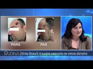 Rudina - Klinika Stroka/ Si te kurojme melanomen me metoda alternative! (25 tetor 2018)
