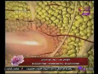 #شاهد بالصور "د.ولاء أبوالحجاج" توضح كيفية وطريقة شفط #الدهون