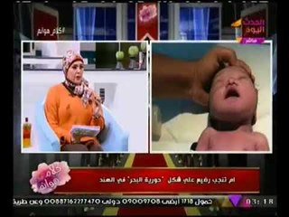 ام تنجب طفل على شكل عروس البحر في الهند