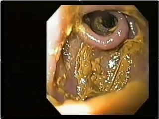 Would have done with our large intestine