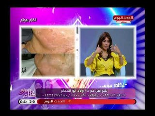 ولاء أبو الحجاج استشاري التجميل توضح طرق جديدة لعلاج البوهاق عن طريق الحقن