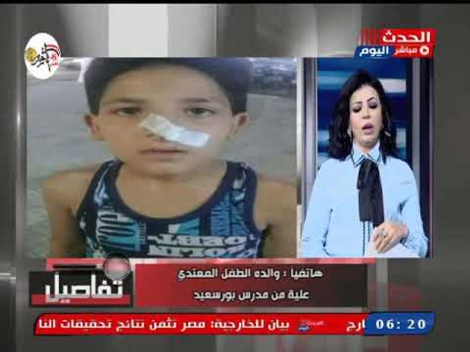 والدة طفل معاق ببورسعيد تروي تفاصيل التعدي عليه بالضرب المبرح تصل لنزيف داخل المدرسة