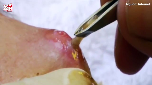 Phê Lòi 27.10.18 Ghê rợn cảnh gắp ấu trùng ruồi trâu ký sinh trên da: Yếu tim đừng xem!