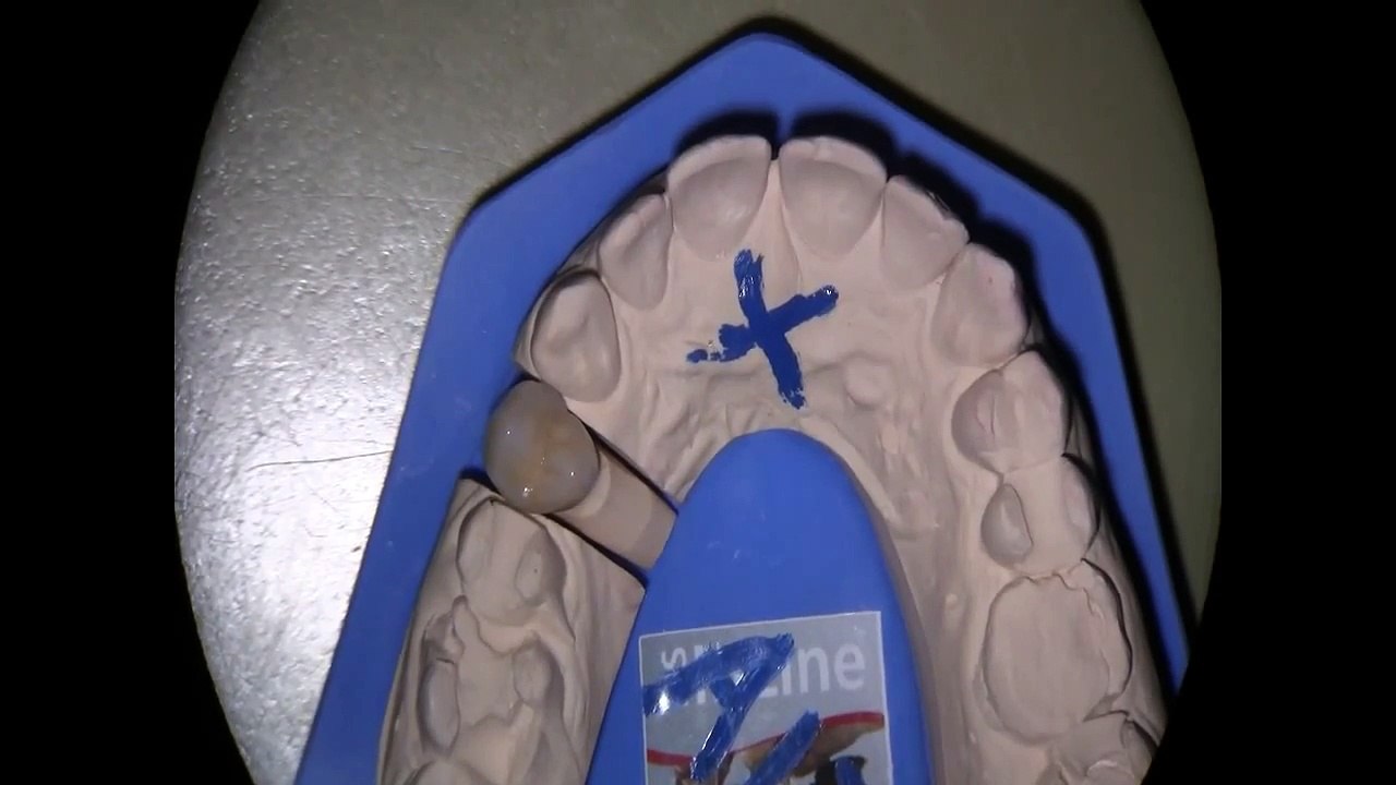 Undichte Zahnkronen sehen so aus