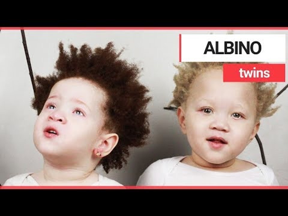 Parents of rare albino twins accused of having affairs | SWNS TV