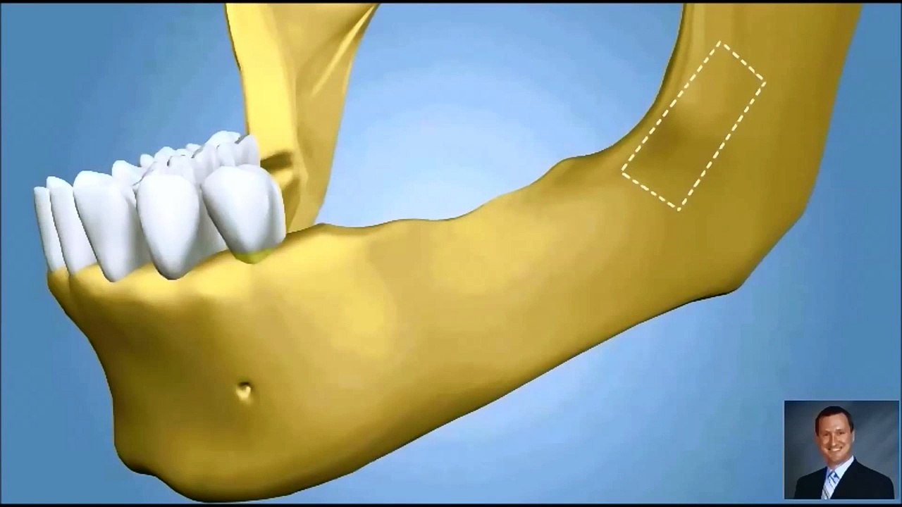 Dental Implants