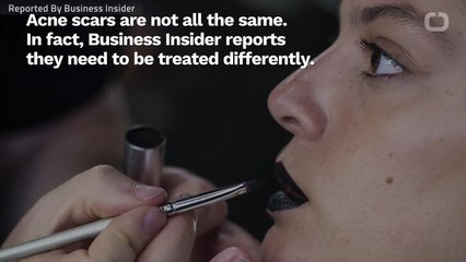 Essential Step to Effectively Treat Acne Scars 🩹