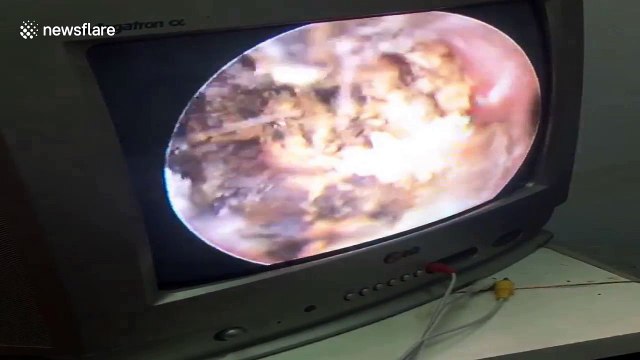 Doctor removes 15 years' worth of gunk from woman's clogged ear