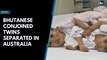 Bhutanese conjoined twins separated in Australia