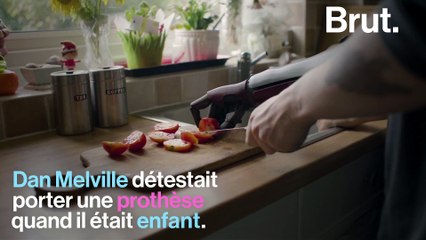Né sans bras droit, Dan Melville a un bras bionique