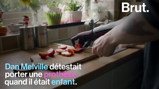 Né sans bras droit, Dan Melville a un bras bionique
