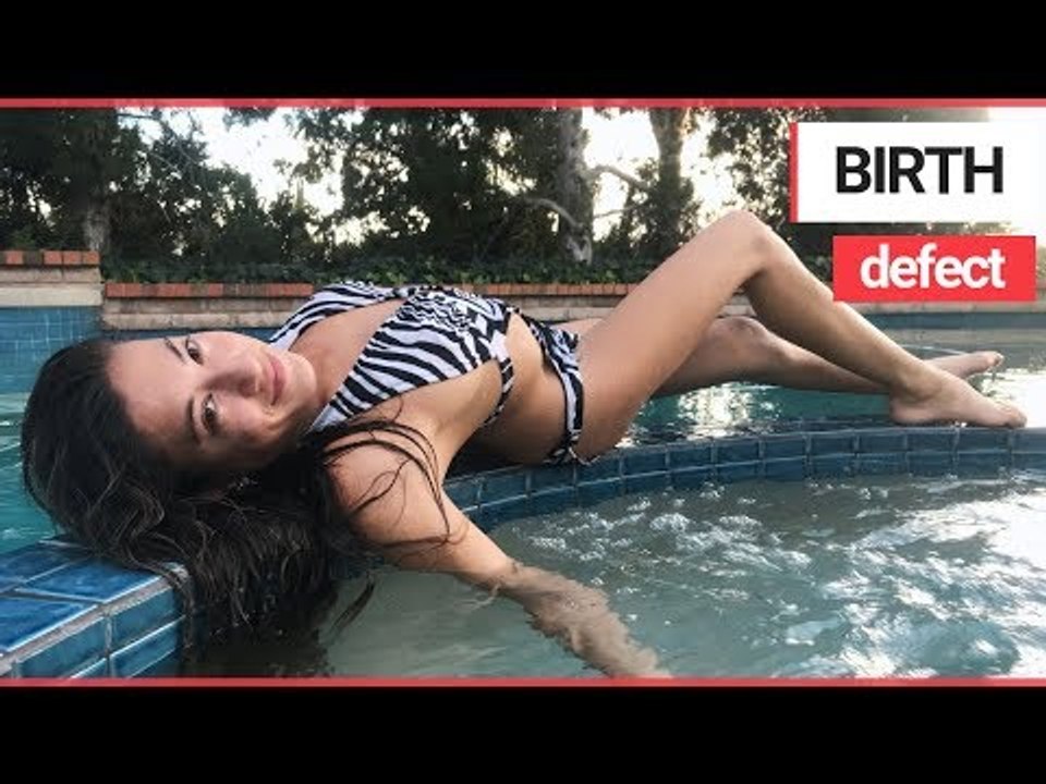 Woman with Spina Bifida Says Boys Wanted to Date in Secret Because they were 'Ashamed' | SWNS TV