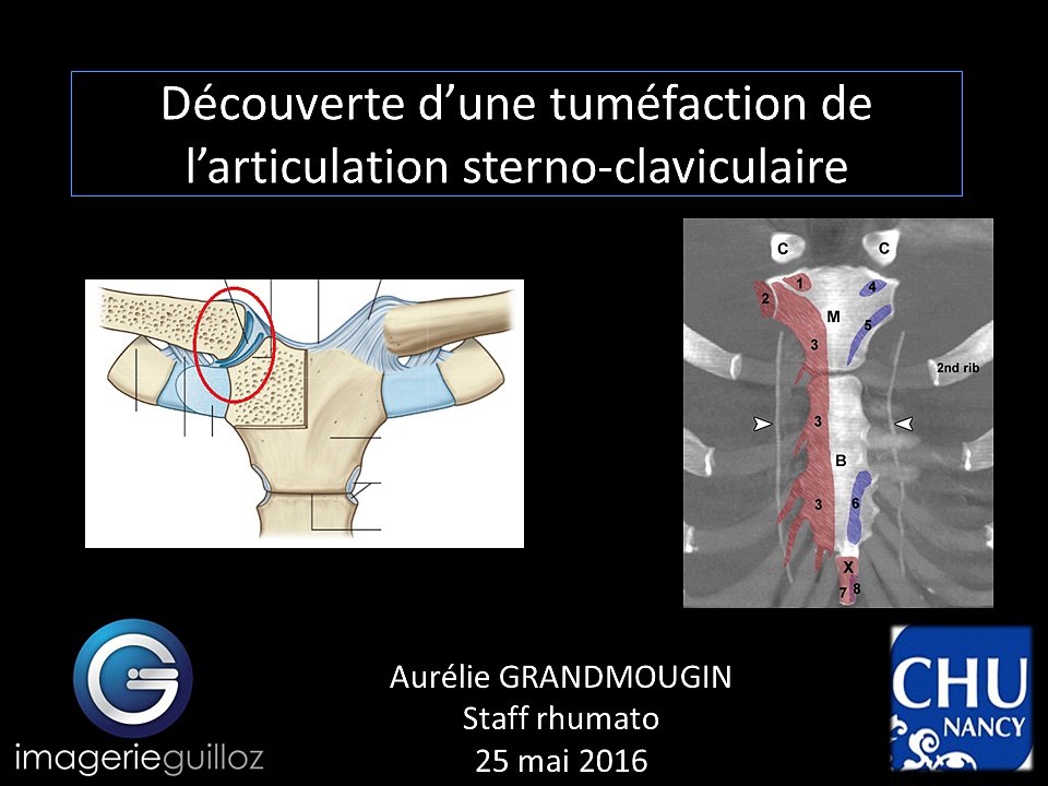 Tuméfaction de l’articulation sterno-claviculaire