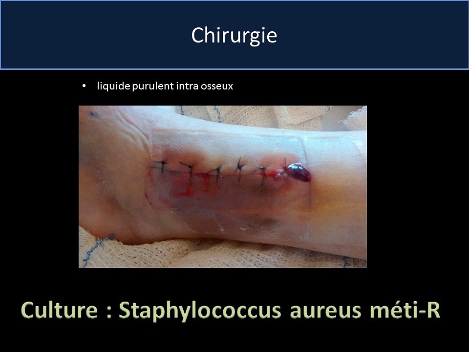 Une jambe bien douloureuse...