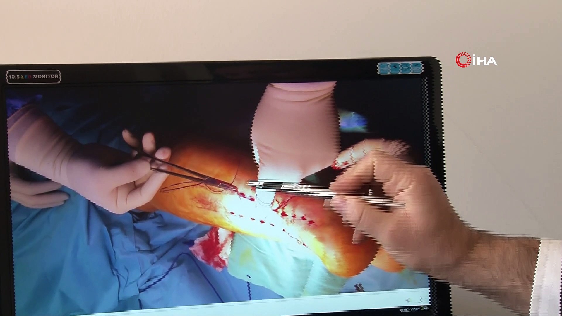 Türk doktoru aşil tendonu ameliyatı için yeni teknik geliştirdi -  Dailymotion Video