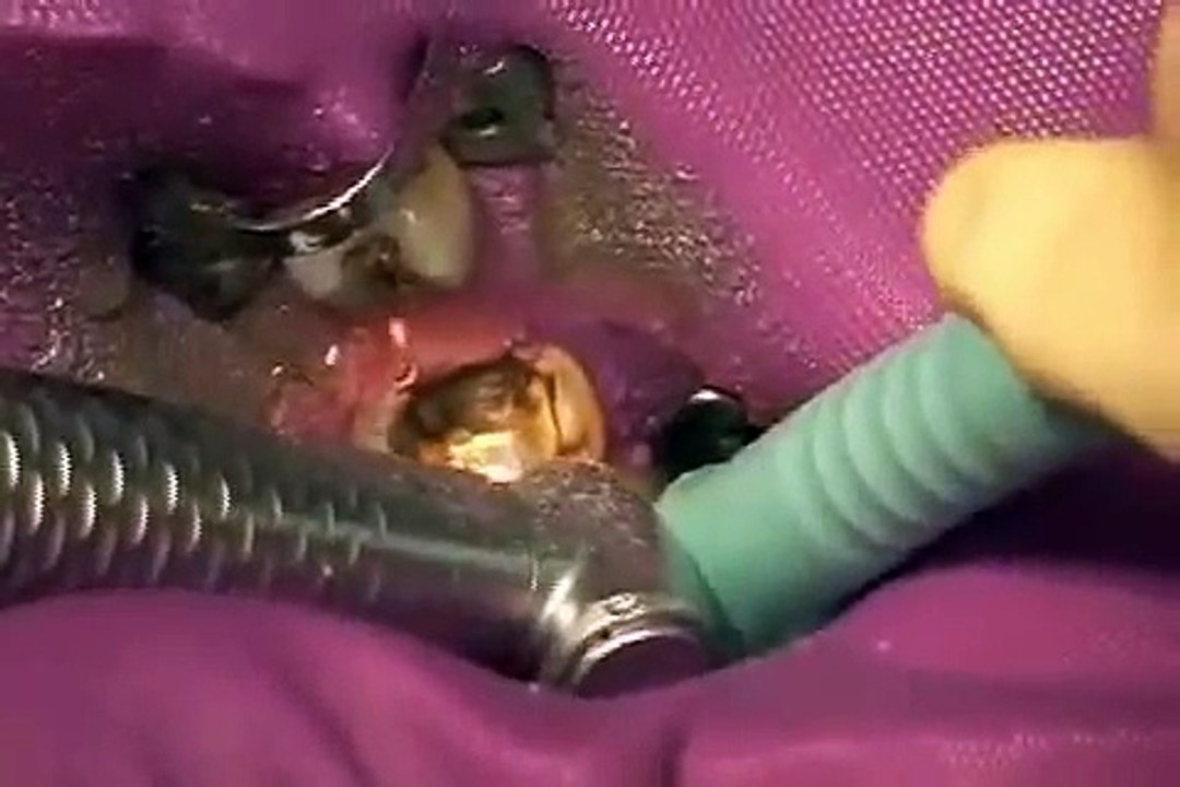 Gehören Amalgamverfärbungen entfernt?