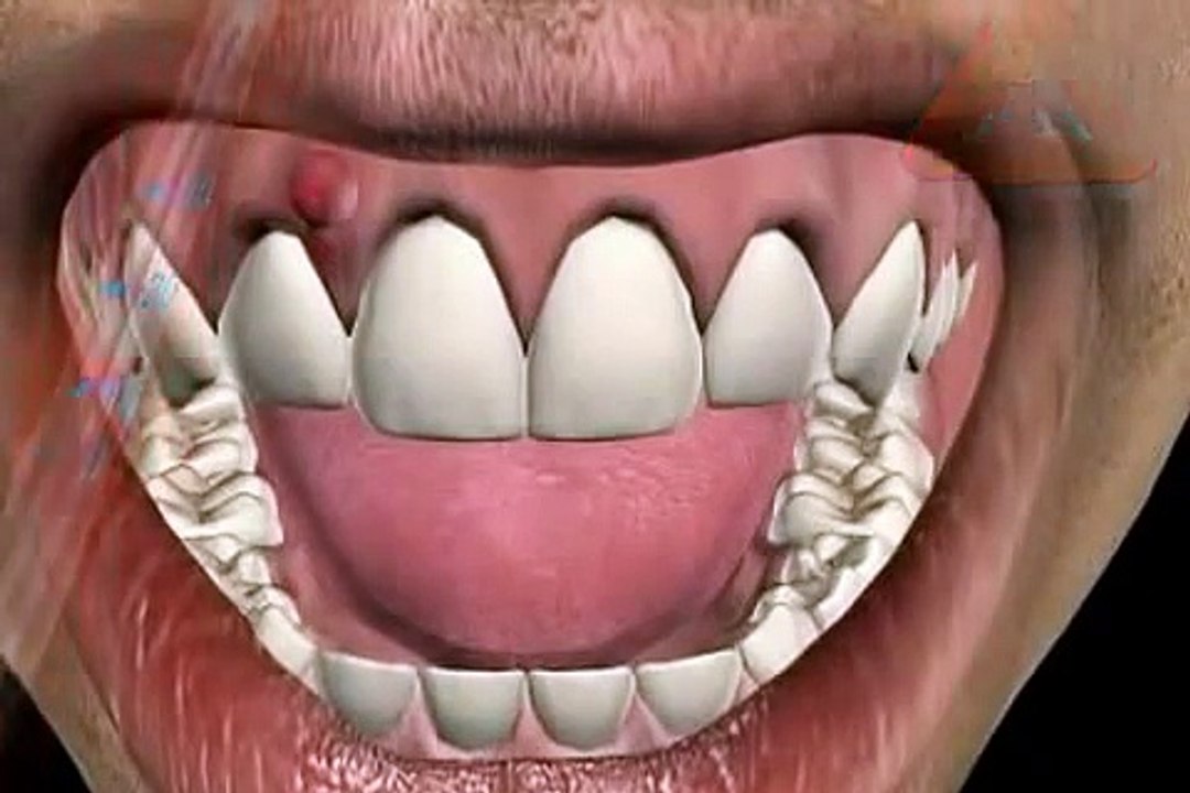 Was ist ein Zahnabszess - Zahnfleisch Abszess