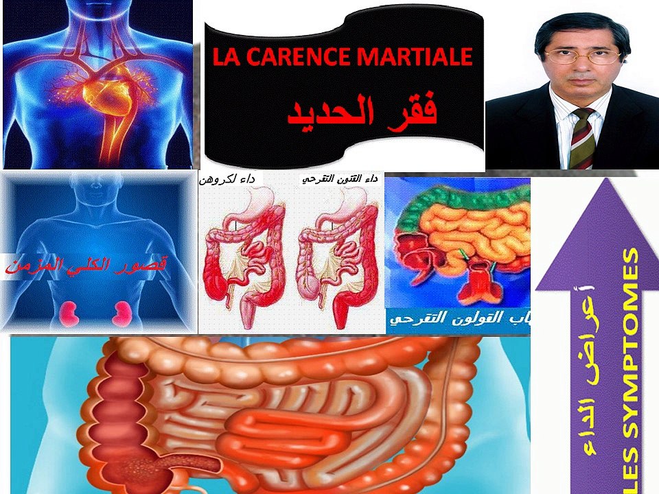 Les conséquences de la carence martiale au-dela de l'anémie  نتائج فقر الحديد ما وراء فقر الدم