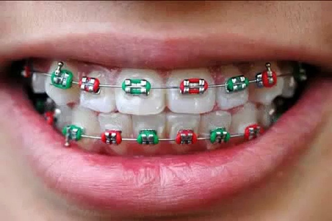 Was sind Brackets und wie werden sie am Zahn befestigt