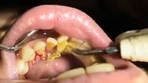 Most satisfying teeth cleaning you'll ever see