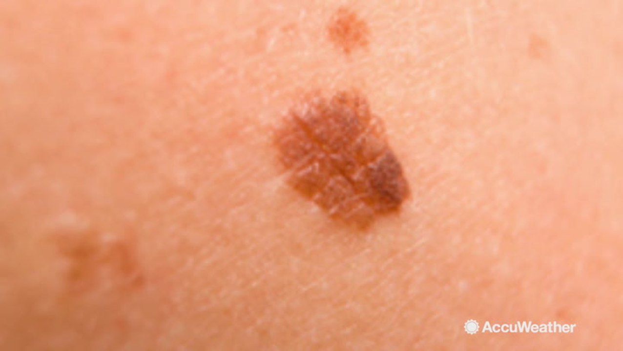 May is Melanoma Awareness Month