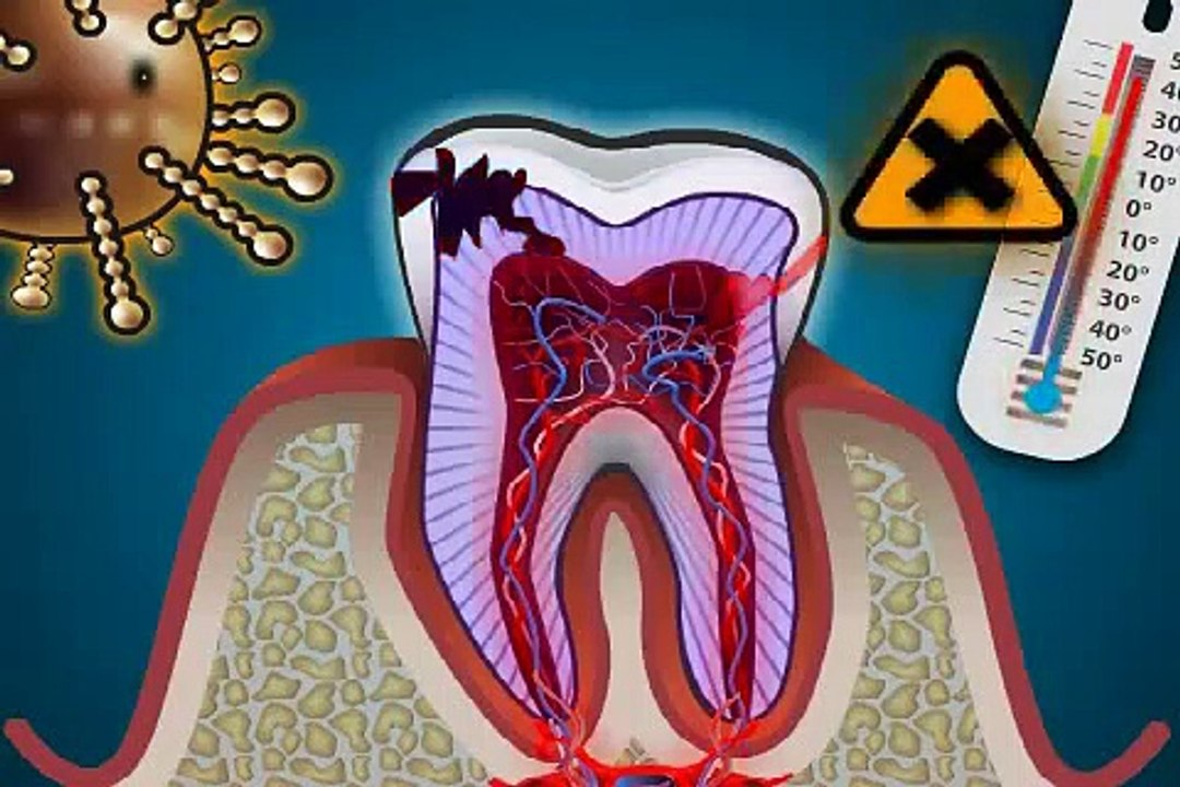 wie gehört eine Zahnnerventzündung - Pulpitis - behandelt