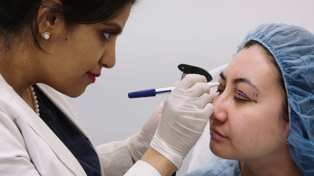 Here's What Upper Eyelid Blepharoplasty Looks Like  | The Plastics