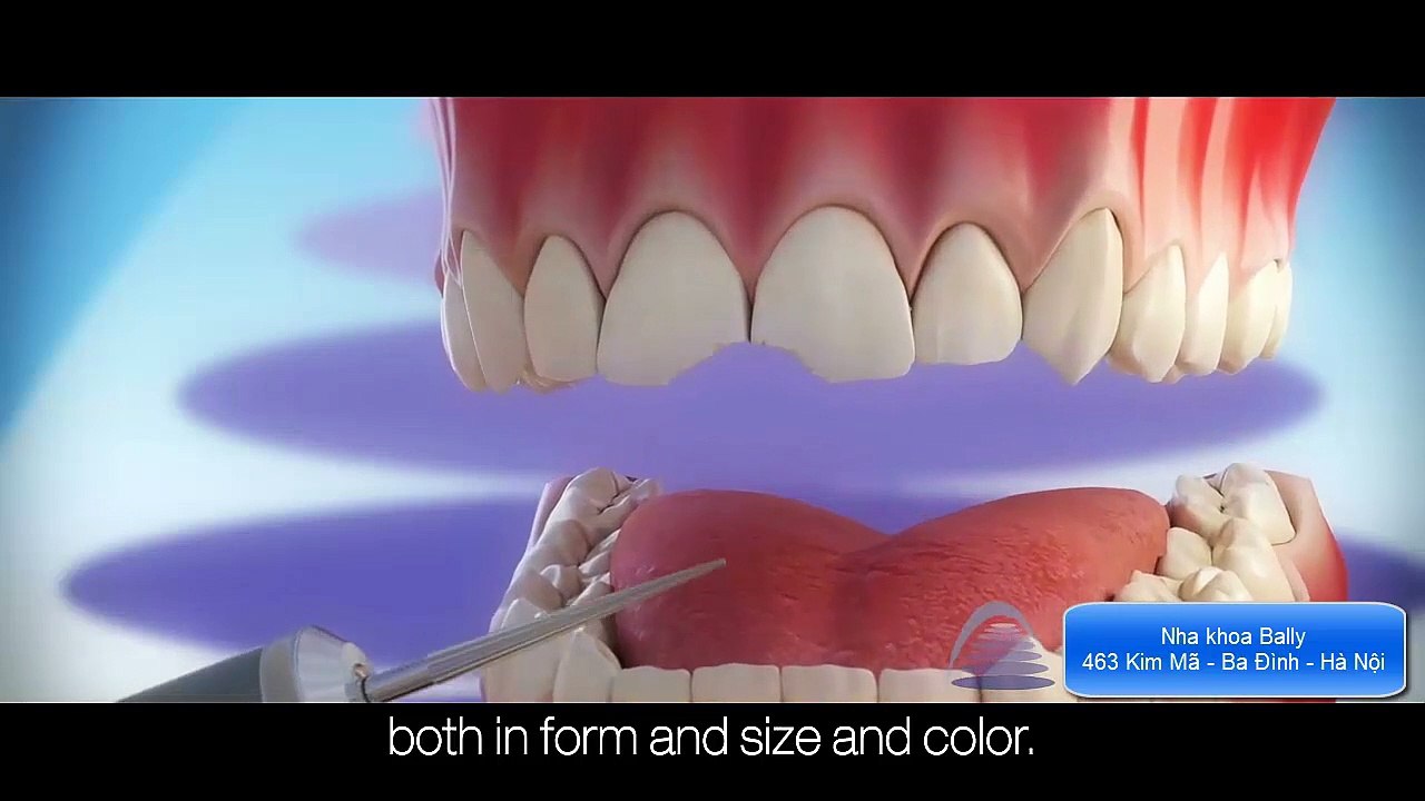 Làm mặt dán sứ Veneer siêu mỏng được thực hiện thế nào?  Mô hình hoàn chỉnh