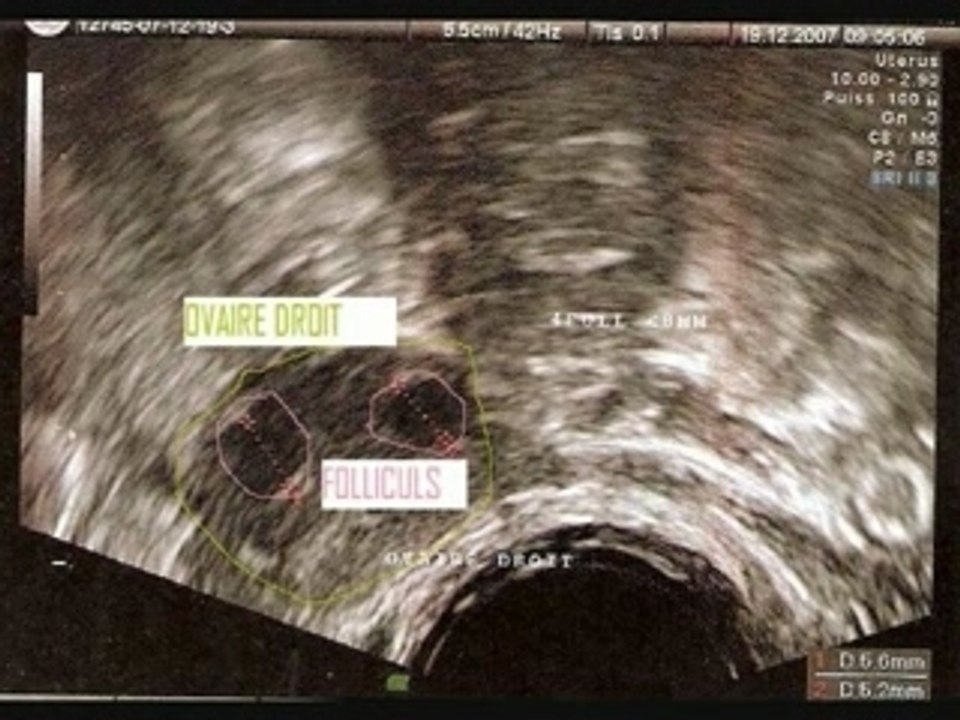 Echographie a J3