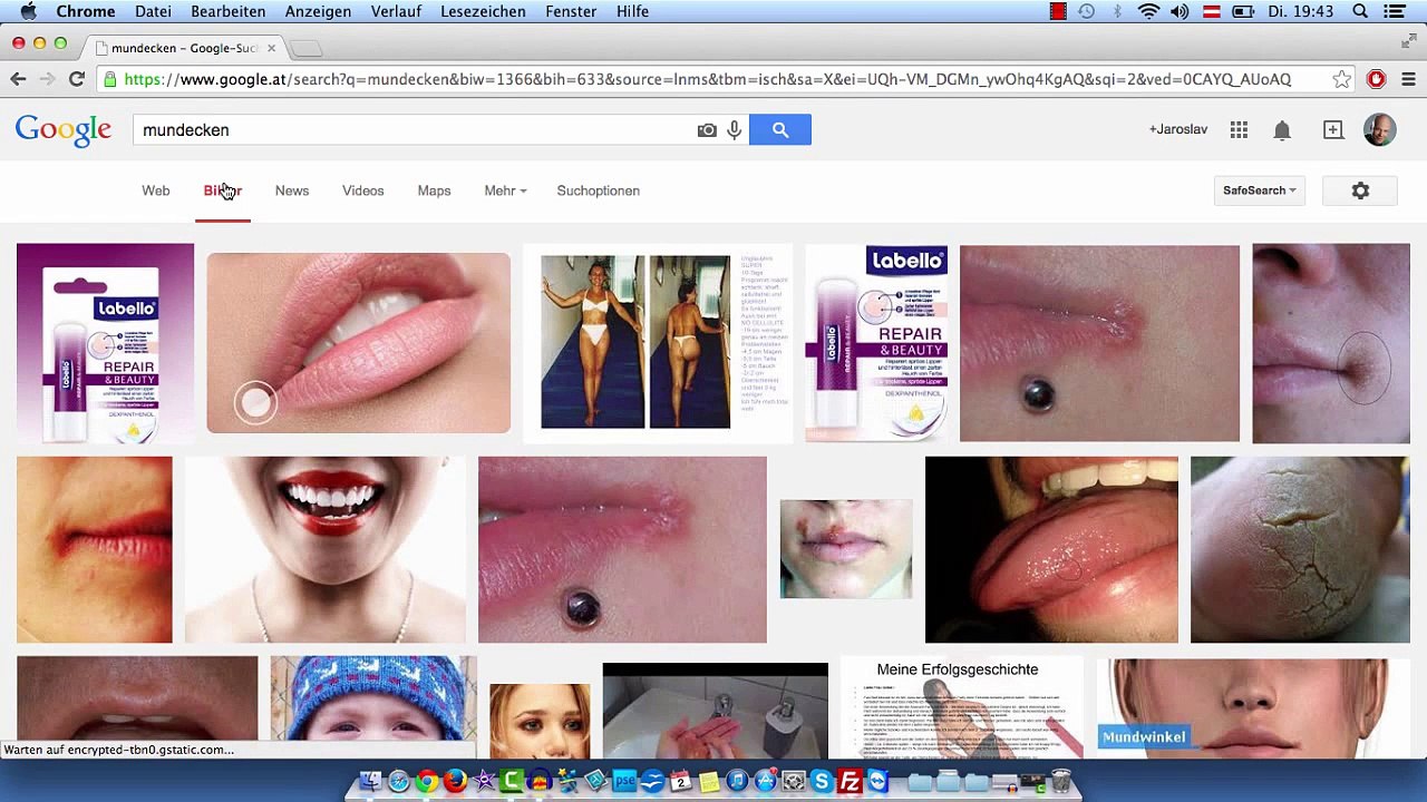 Wie behandelt man Mundecken oder Rhagaden?