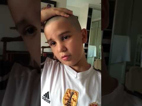 Alopecia Areata: crianças mostram que a amizade contribui na luta contra a doença