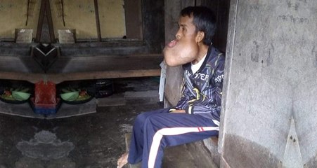 Basketbol Oynarken Çenesine Darbe Alan Talihsiz Gencin, Hayatı Karardı