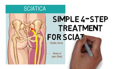 Shocking Home Treatment For Sciatica Pain - Treatment Methods From Home (2)