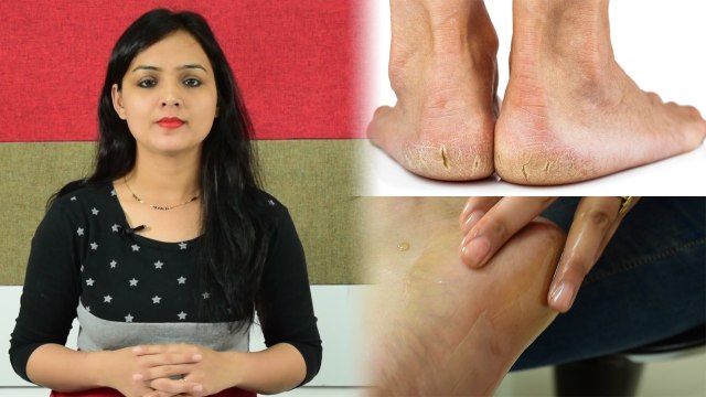 Crack Heels: DIY Healing Pack At Home| घर पर इस पैक से दूर करें फटी एड़ियां | Boldsky